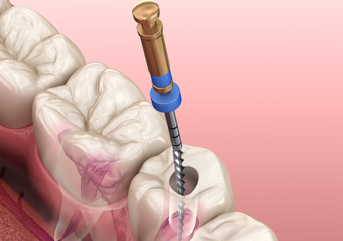 Signs of Root Canal Infection in Alpharetta GA Area