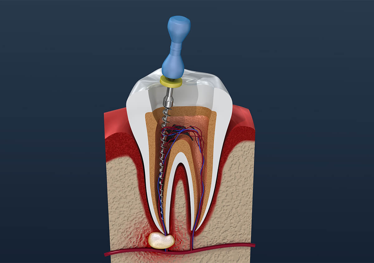 Root Canal with Crown in Alpharetta GA Area